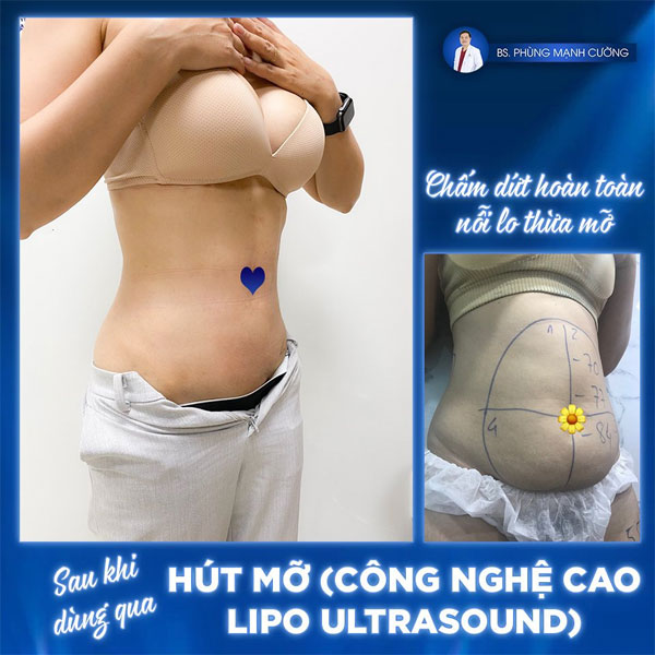 Hình ảnh bệnh viện thẩm mỹ Gangwhoo Lừa Đảo Khách hàng đi giảm mỡ vùng bụng